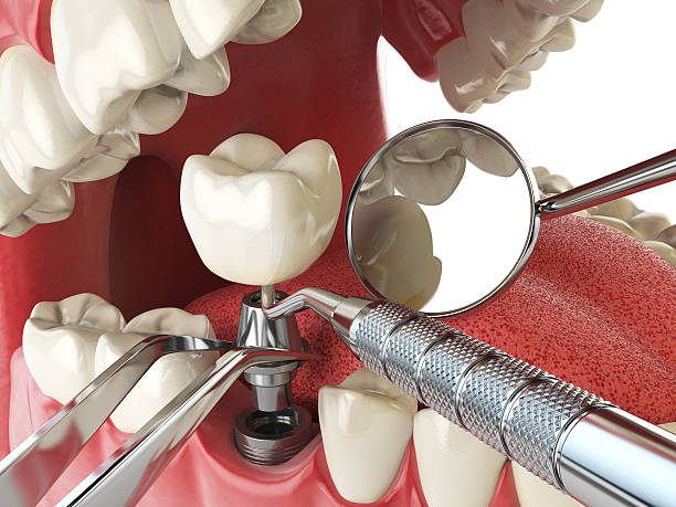 Best Emergency Wisdom Teeth Removal in Parkland, FL