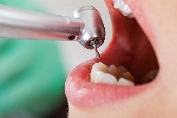 Best Emergency Root Canal Treatment in Parkland, FL